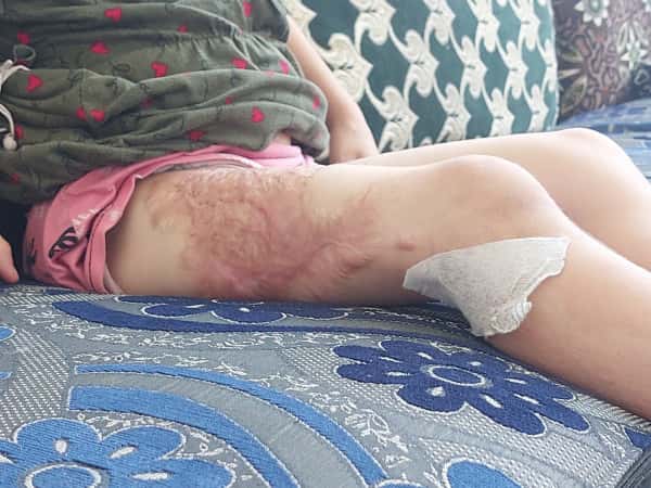 Sidra suffered severe burns and needs your help!