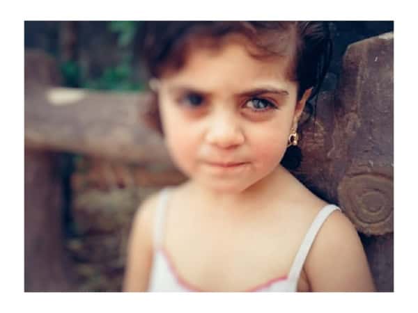 A girl child needs corneal transplant