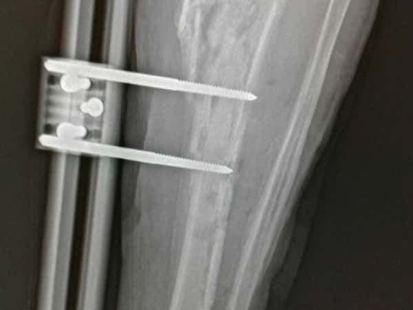 A refugee needs an operation in his foot