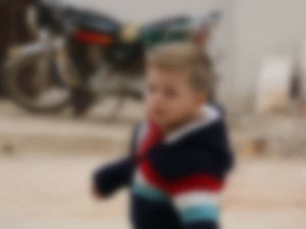 طفل فقد بعض جمجتمه