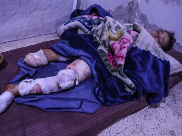 A Child whose Leg is Amputated in Need of Medication Costs