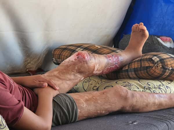 A shell burned Ahmed's body and his childhood.