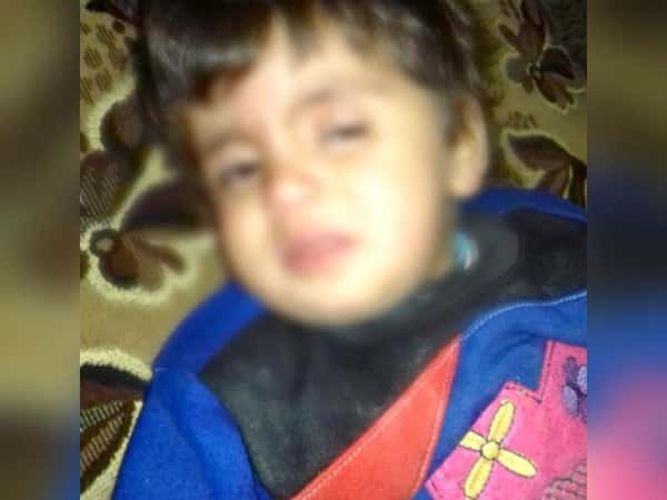 طفل يعاني من مرض كبدي.