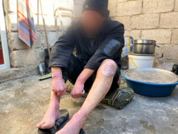 Relief for Khaled’s Pain