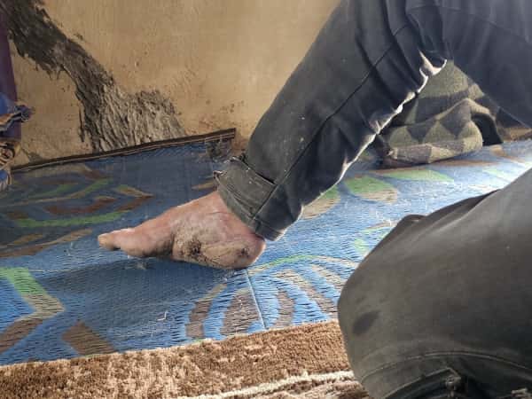 إصابةٌ في القدم منعته من العمل