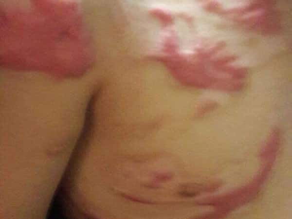 A refugee suffering from burns in the facial and chest area
