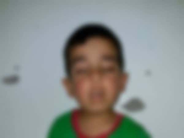 Child needing eye surgery