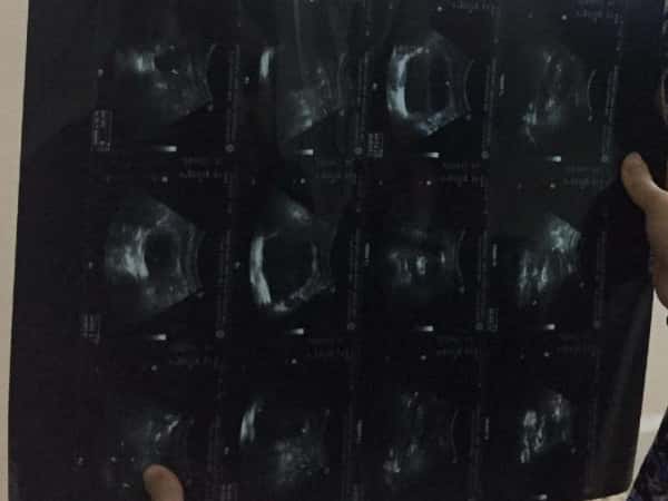 A child suffers of problems in the urinary tract