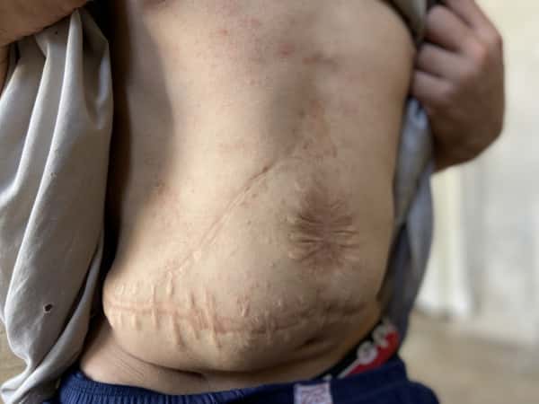 Dirar is a young man who had liver transplant and was diagnosed after with hepatit c! He needs your help!