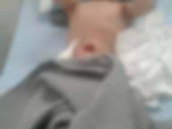 Child suffering from intestinal rupture