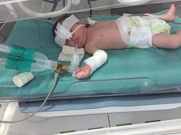 Immediate NICU admission is needed for a newborn