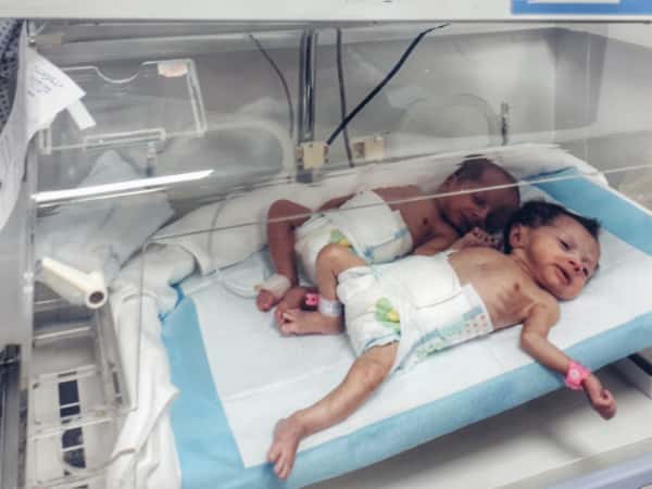 A twin with early delivery