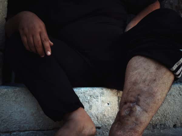 A man with foot injury
