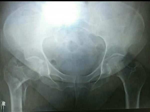 A female refugee is in need of joint transplant