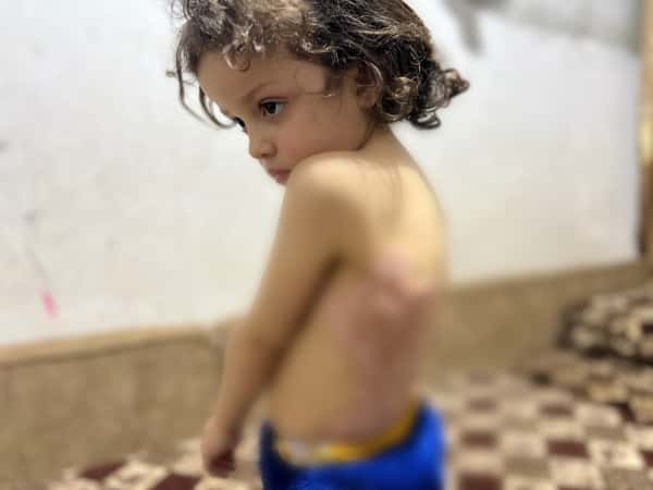 Healing Sidra’s Burns