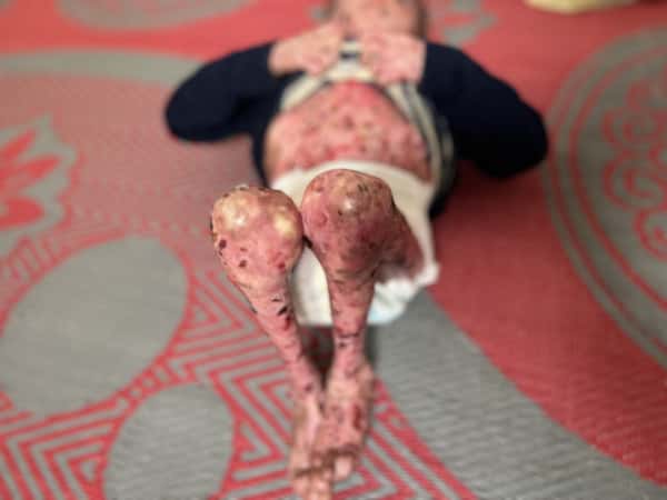 Abdurahman is a child who suffers from pemphigus