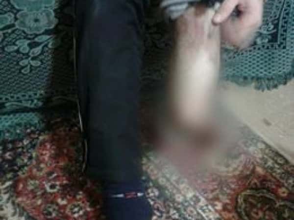 a refugeen in need of a Prosthesis