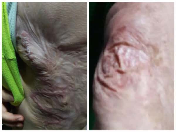 A girl child has severely burned