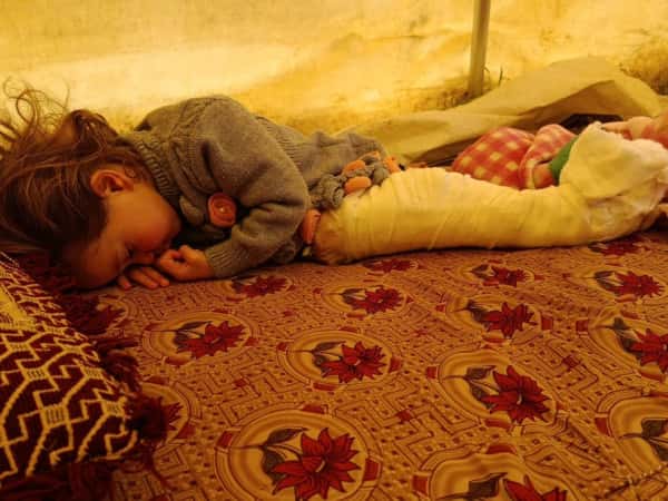 الحروق تلتهم جسد الصغيرة فاطمة