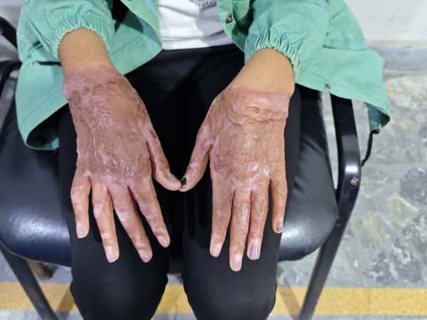 Suffering From Burns and Disfigurements Can Leave a Deep Psychological Impact on The Affected Individual!