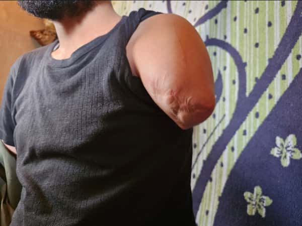 An Injury That Stopped Hassan from Working