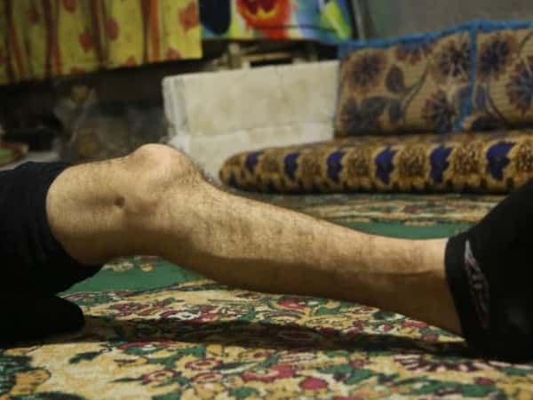 Leg fire injury