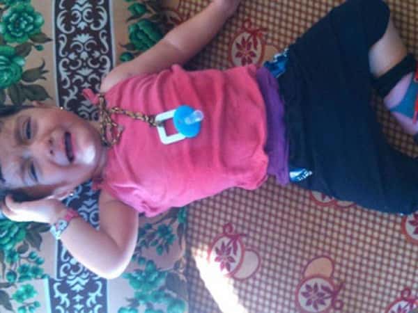 2 years old who needs back and legs braces