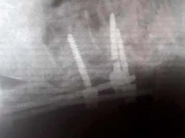 Vertebrae surgery as soon as possible for a breadwinner