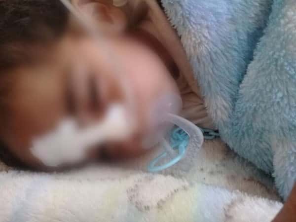 Infant with multiple conditions needs support