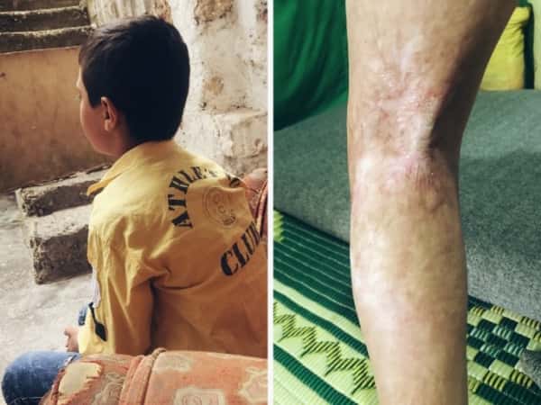 طفل تعرض لحرق في قدمه!