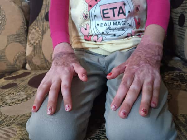 She is in physical and psycological pain due to her burn injuries!