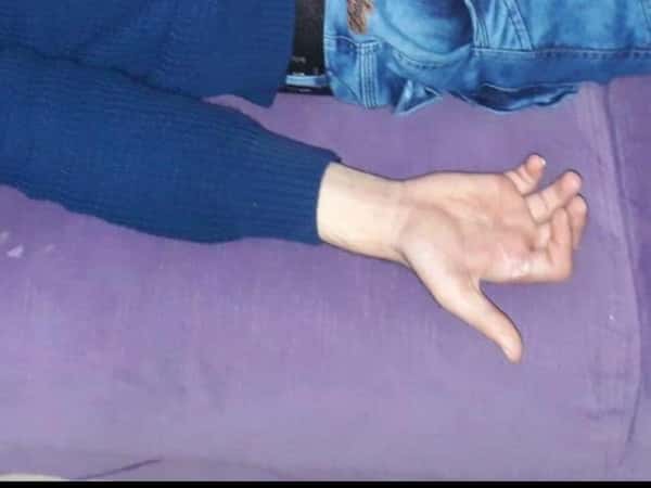 شاب أُصيبت يده جراء غارةٍ جويّة