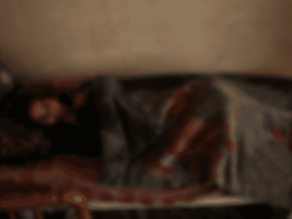 A child suffering from Poilo due to a previous spinal injury.