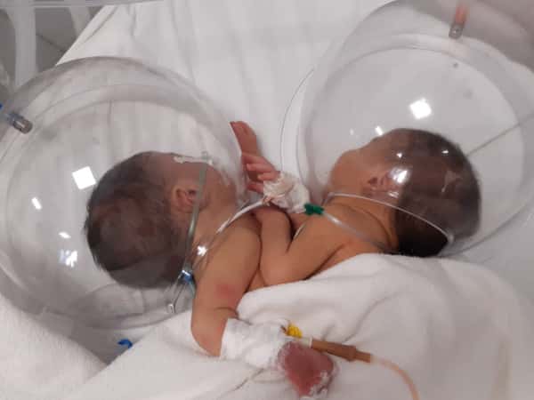 Conjoined twins need your help!