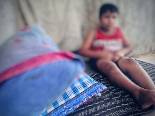 A child suffers from osteocampsia( foot curvature )