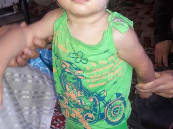 Urgent stitches removal for a toddler
