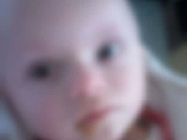 A child suffers from Hydrocephalus.