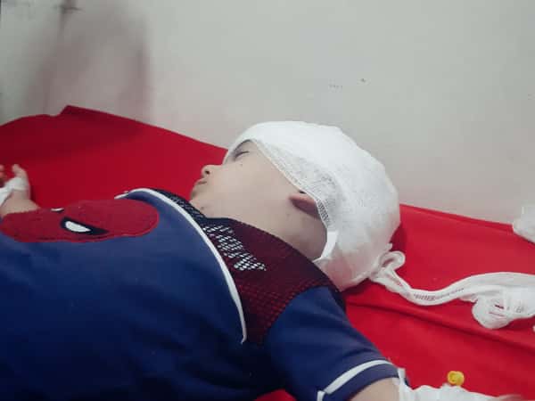 A child with hemophilia