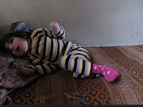 The little girl suffers from atrophy