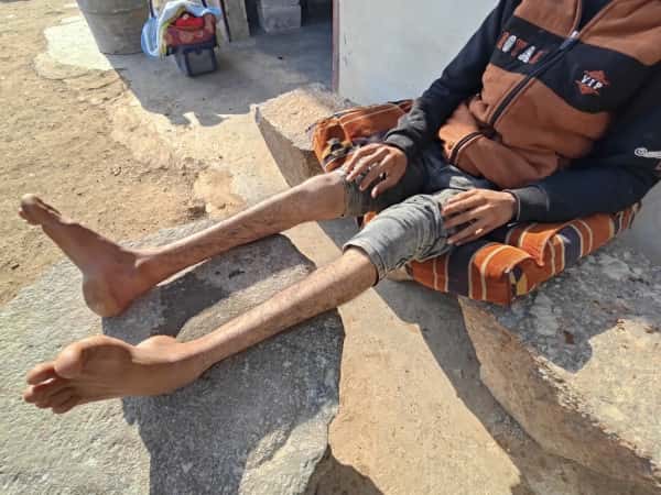 Brain atrophy worries the family