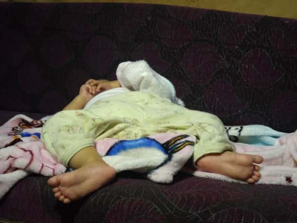 newborn with developmental hip dysplasia