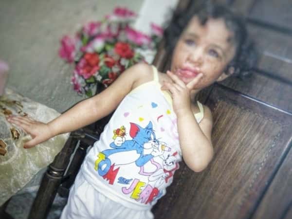 A girl child with severe burns