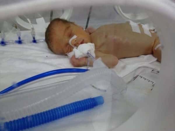 a baby needs NICU admission to survive