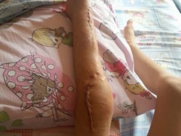A Child Needs Medical Shoes