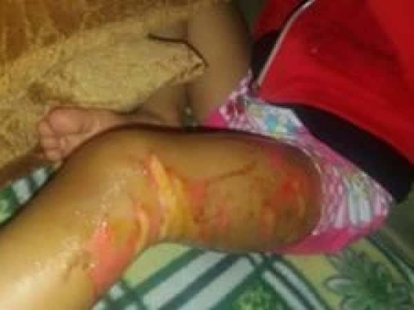 A kid suffering from burns