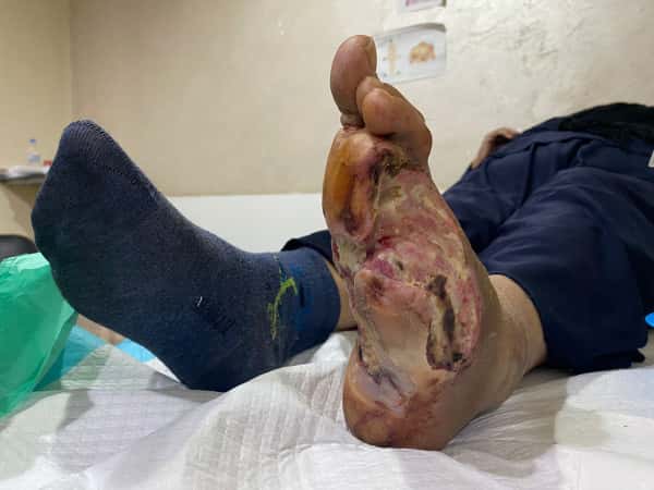 You can be the reason to save half of Najah's leg from getting amputated!