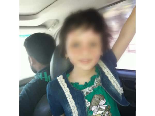 طفلة تعاني من تشوه في الوجه بسبب الحروق