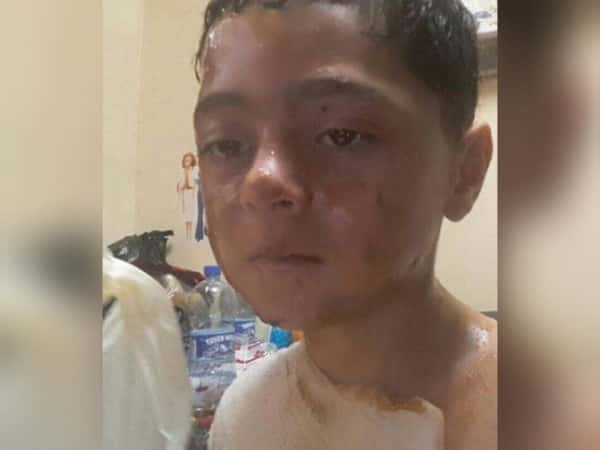 A refugee with face and chest burns