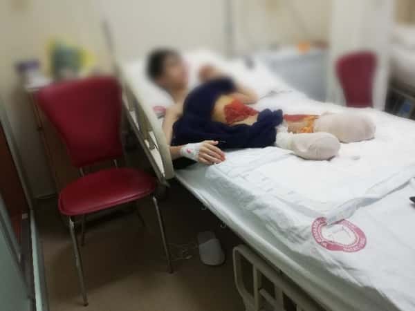 A child that has lost his legs and the union with his family to get proper treatment