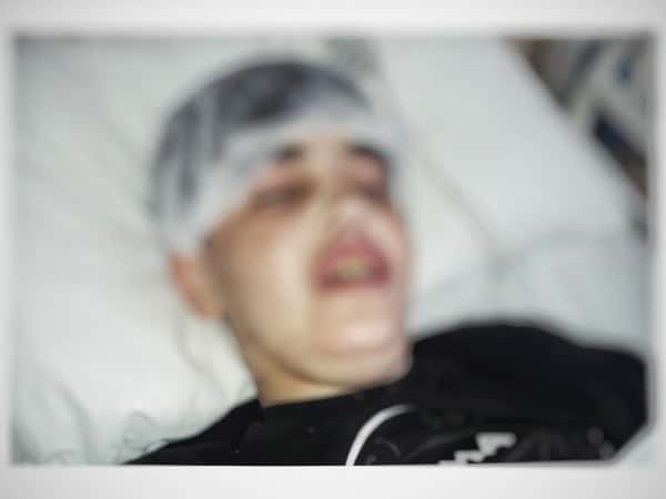 A child with Crohn disease